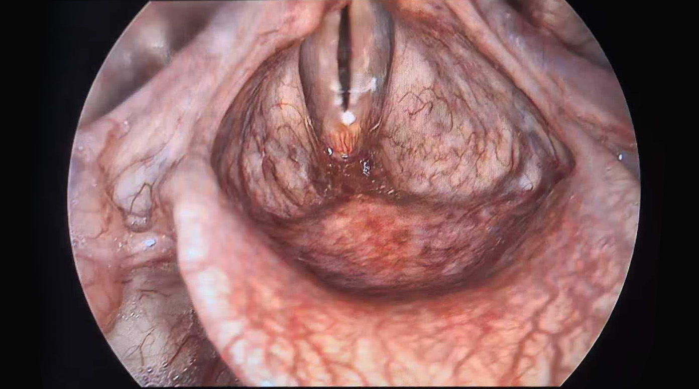Can be matched with stroboscopic light source for stroboscopic laryngoscopy