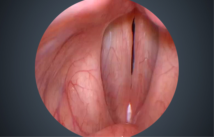 Can be matched with stroboscopic light source for stroboscopic laryngoscopy